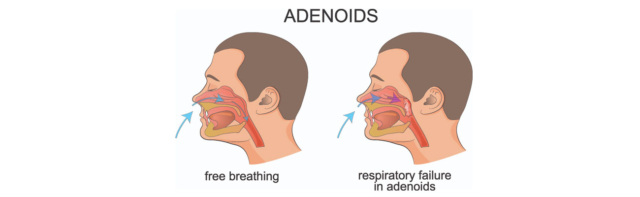 Adenoid Surgery
