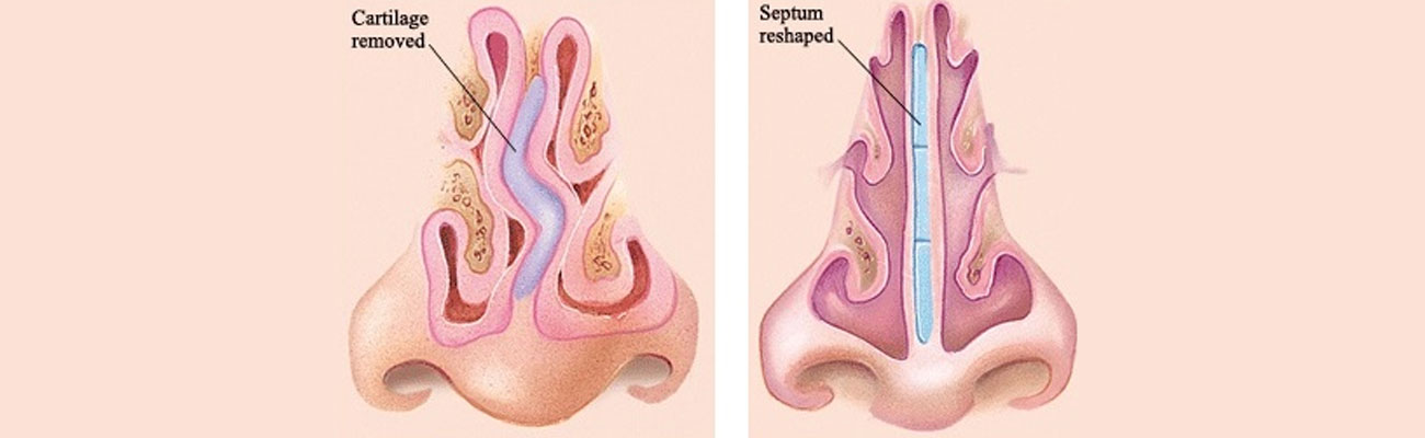 Endoscopic Septoplasty