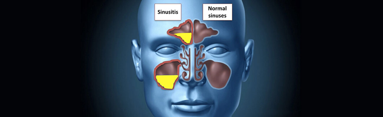 Endoscopic Sinus Surgery