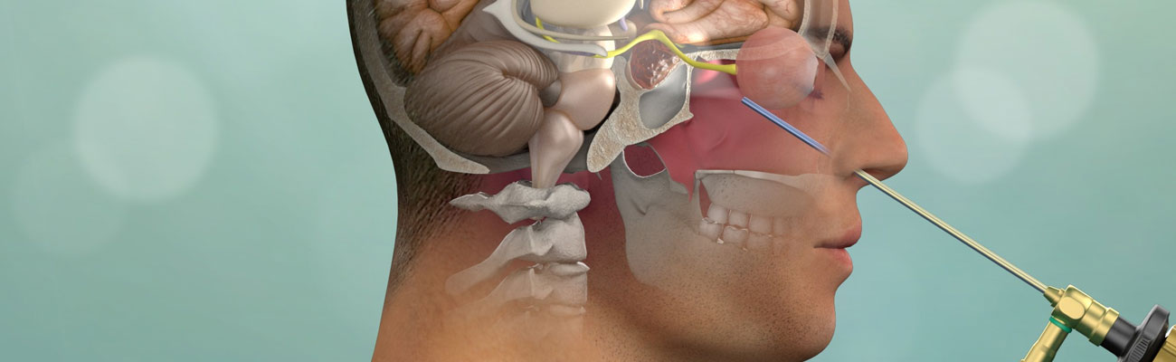 Endoscopic Skull Base and Pituitary Surgery