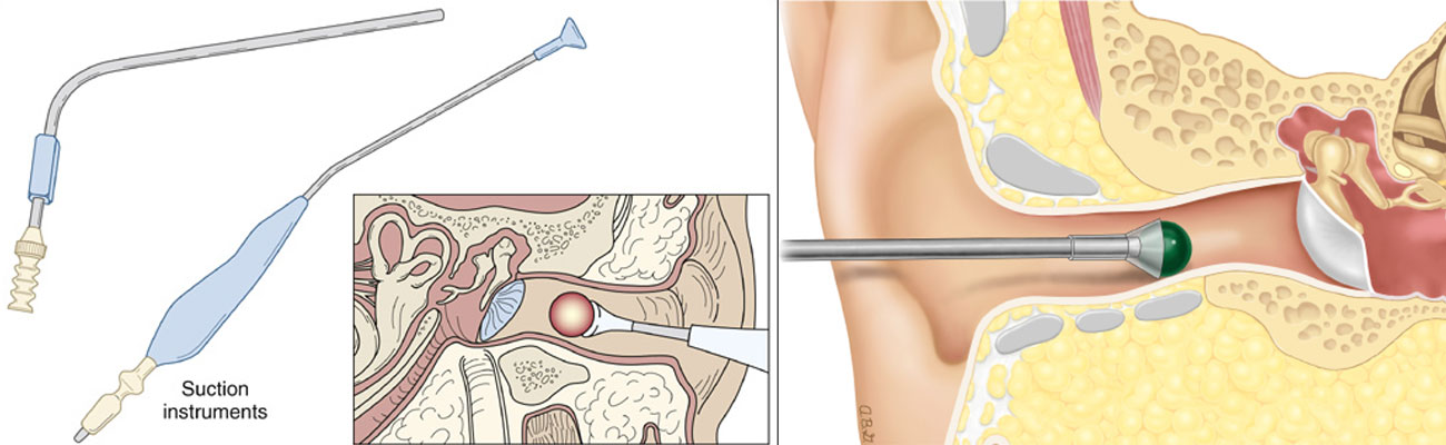 Foreign Body Removal