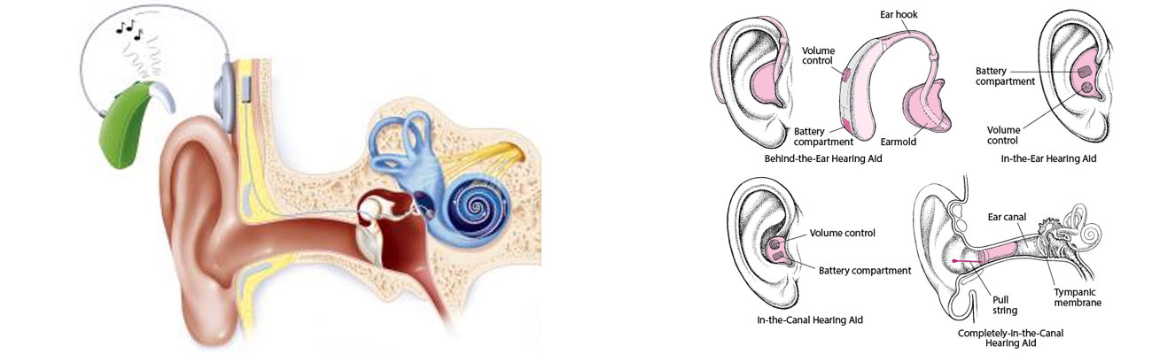 Hearing Loss Treatment