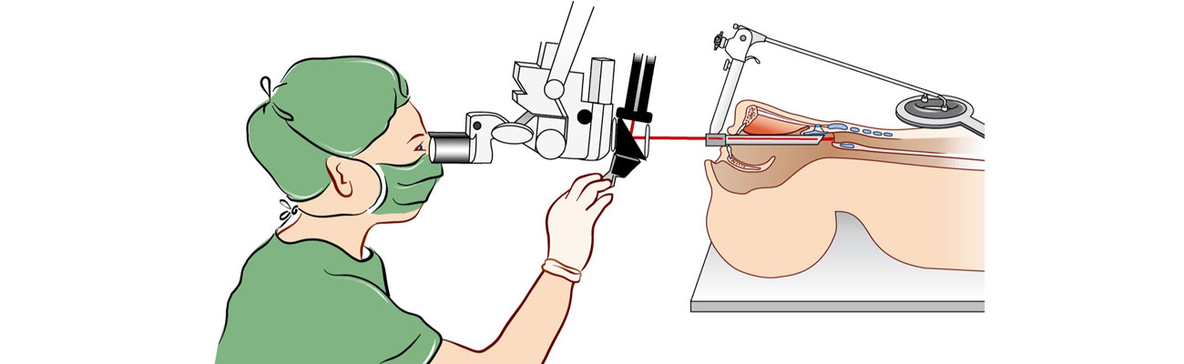 Microlaryngoacopy