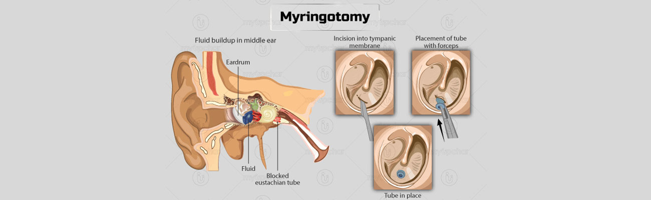 Myringotomy