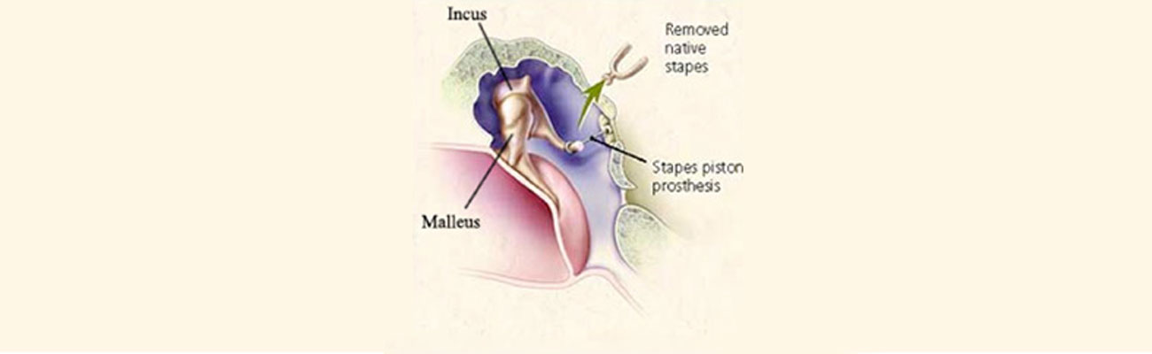 Ossiculoplasty