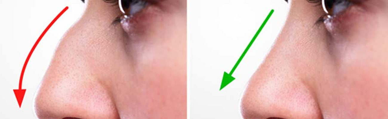 Septorhinoplasty