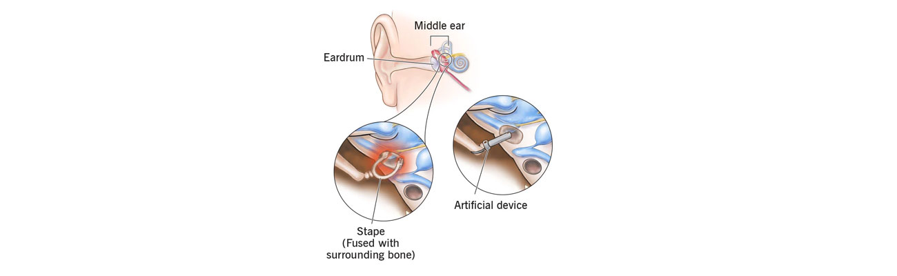 Stapedectomy