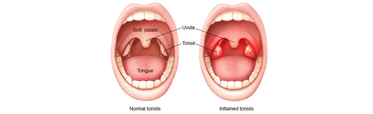 Tonsillectomy
