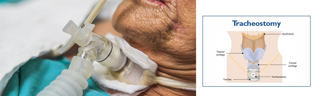 Tracheostomy
