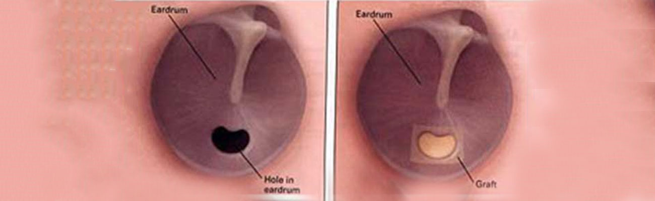 Tympanoplasty